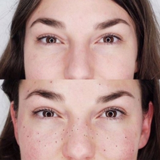 Freckle Control Treatment in Delhi 