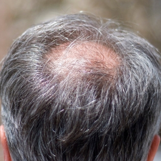 Types of Hair Loss 