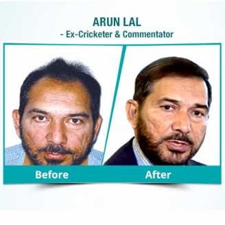 Is Hair Transplant The Best Way To Enhance Hair Growth And Density