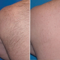 Laser Hair Removal Treatment in Delhi 