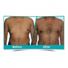 Male Breast Reduction Surgery in Delhi 