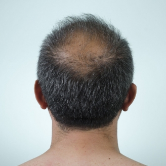 What is Alopecia Hair Loss  TypesCausesDiagnosis and Treatment  By  Looks Forever Hair And Skin Aesthetic Clinic  Lybrate