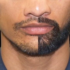 Moustache and Beard Transplant 