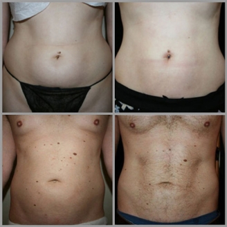 Non Surgical Liposuction in Delhi 