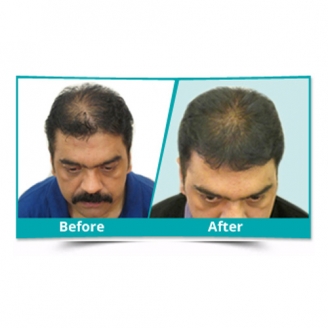 PRP Treatment in Delhi 