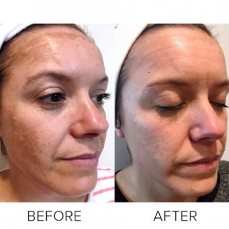 Pigmentation Treatment in Delhi 