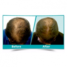 Scalp Rejuvenation Treatment 