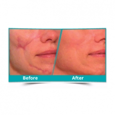 Scar Reduction Surgery in Delhi 