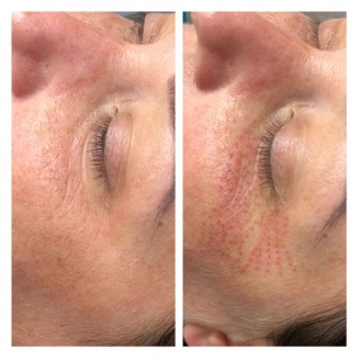 Laser Skin Tightening, Sydney Cosmetic Laser