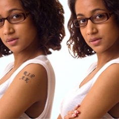 Tattoo Removal in Delhi 