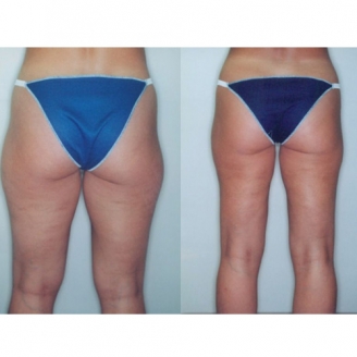 Thigh liposuction in Delhi 