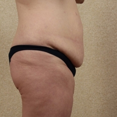 Tummy Tuck Cosmetic Surgery in Delhi 