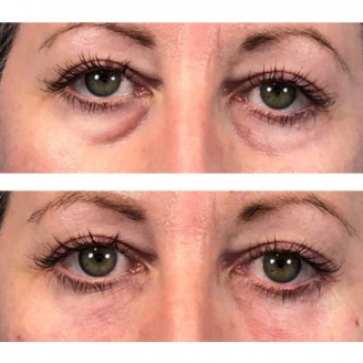 Under Eye Rejuvenation in Delhi 