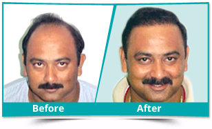 Before and After Result