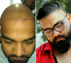 Result of Hair Transplant Treatment