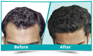 We Care Hair Transplant Clinic in Adajan Dn,Surat - Best Hair Treatment  Clinics in Surat - Justdial