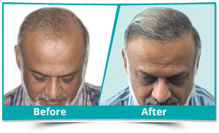 Before and After Result of Male Hair Transplant