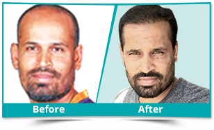 Kota Hair Transplant Results Photo Gallery | Medispa Jaipur