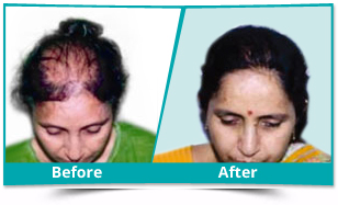 Before and After Result of Hair Transplant
