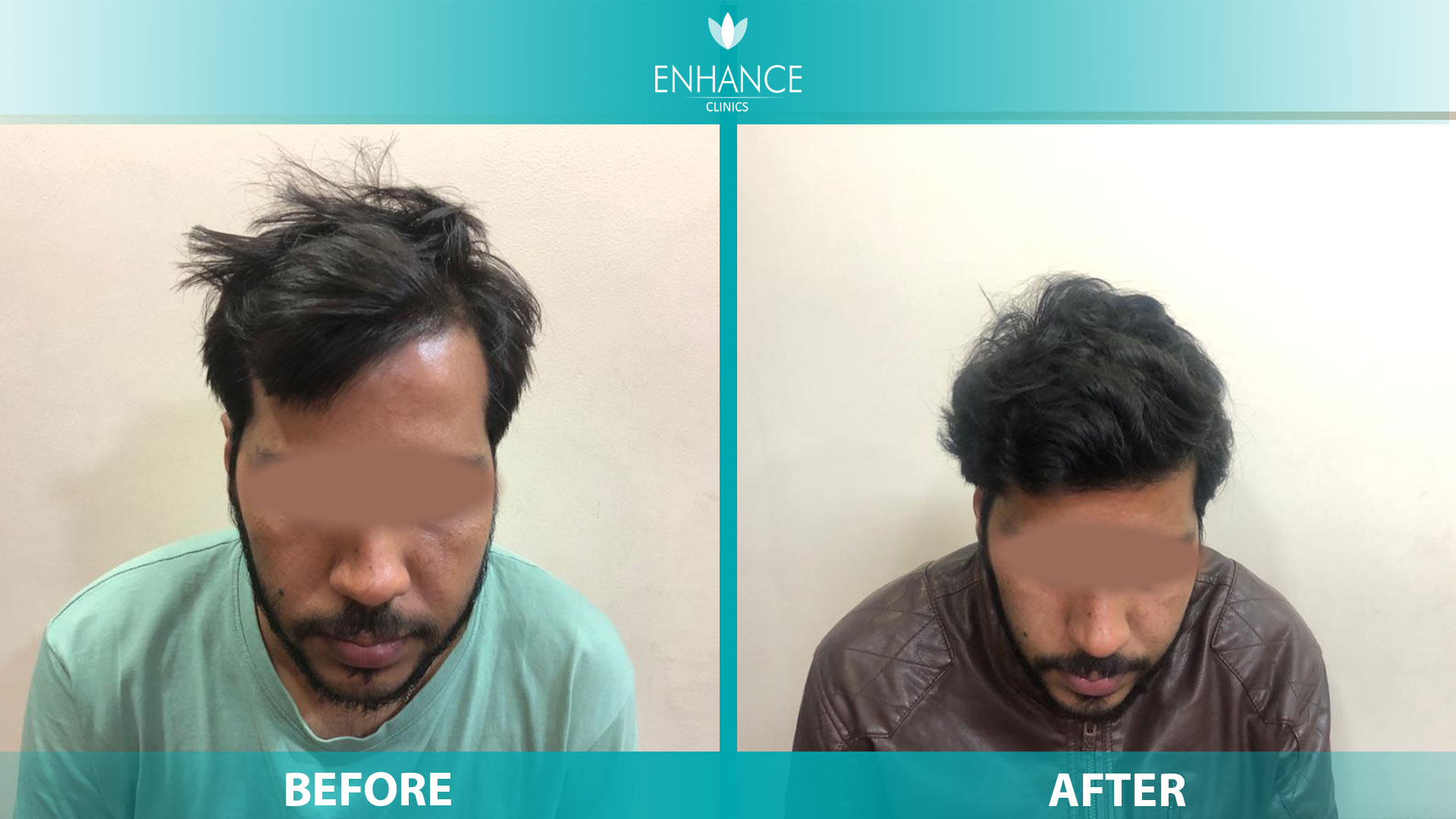 Best Hair Transplant in India | Best Hair Transplant Surgeon in india |  Enhance Clinic