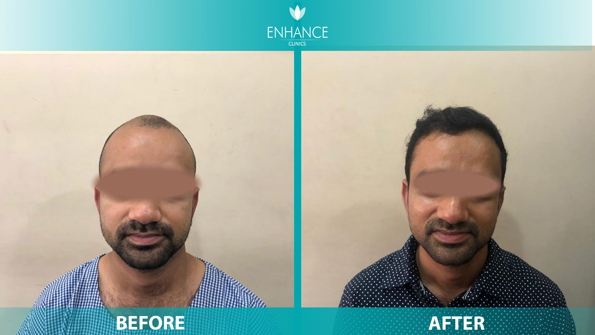 Best Hair Transplant Clinic in Haridwar, India | Regrow Hair Clinic