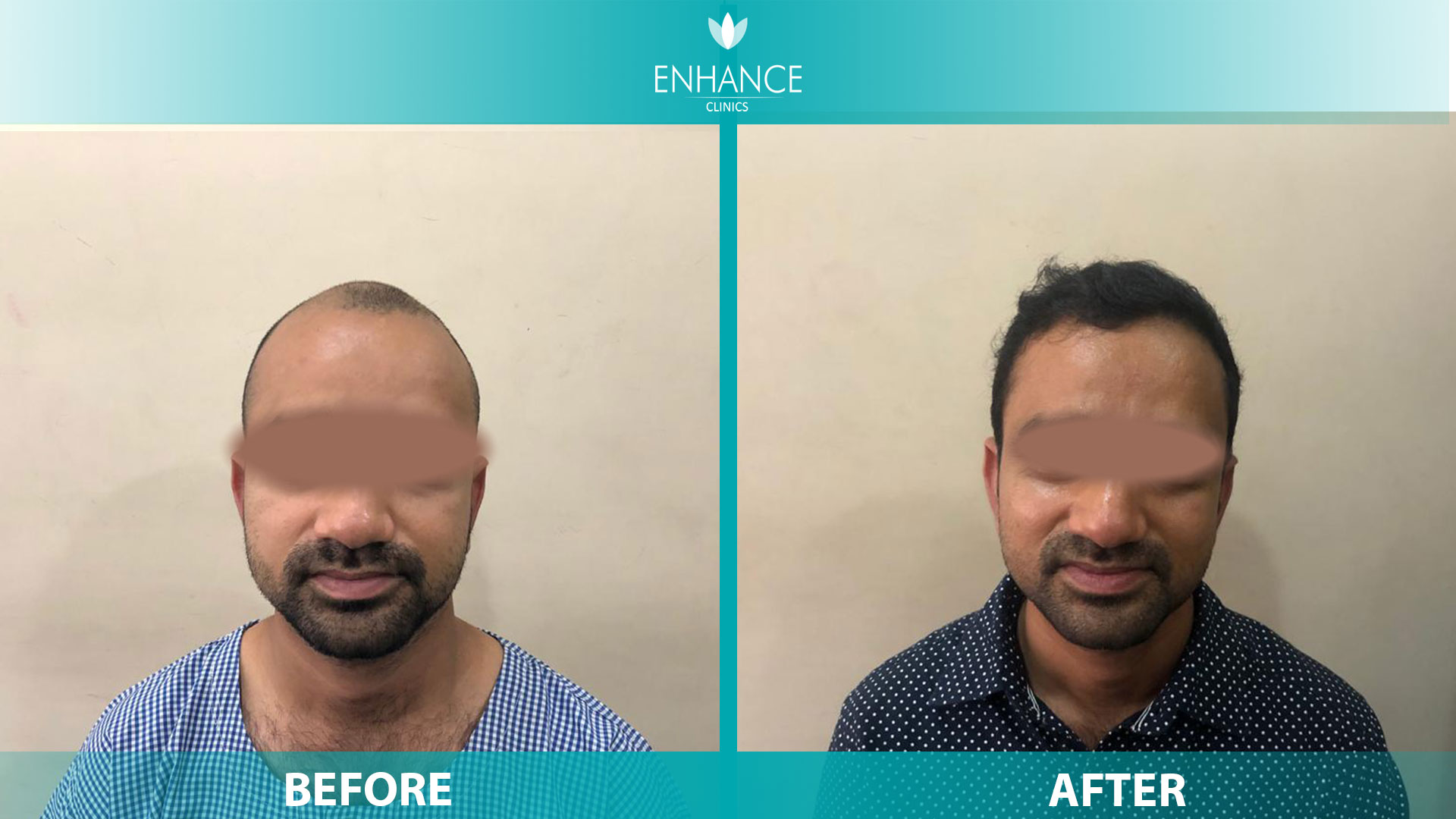 Best NonSurgical Hair Transplant in Bihar Looks Plus