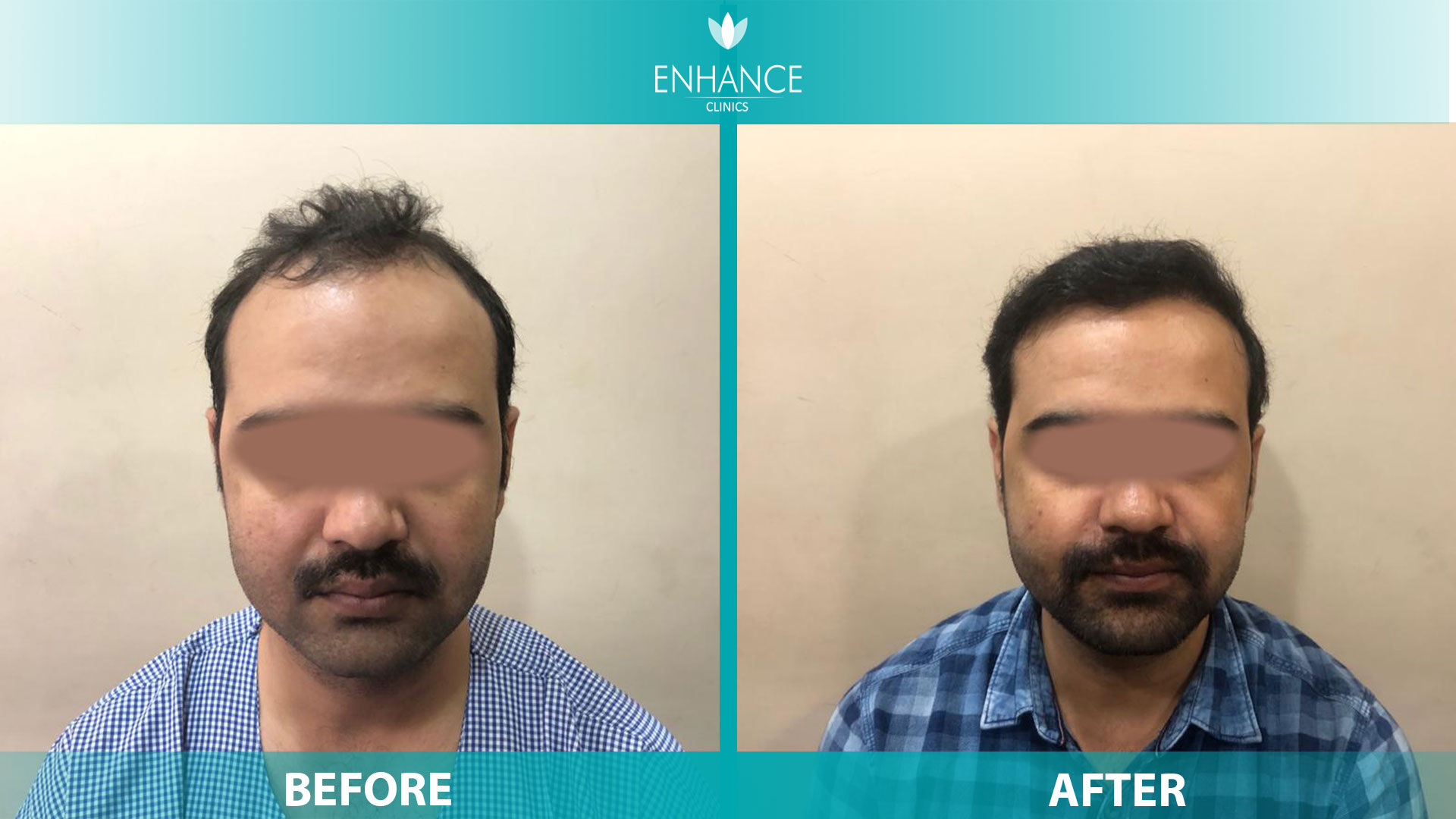 Enhance Clinics in Pedder RoadMumbai  Best Hair Transplant Clinics in  Mumbai  Justdial