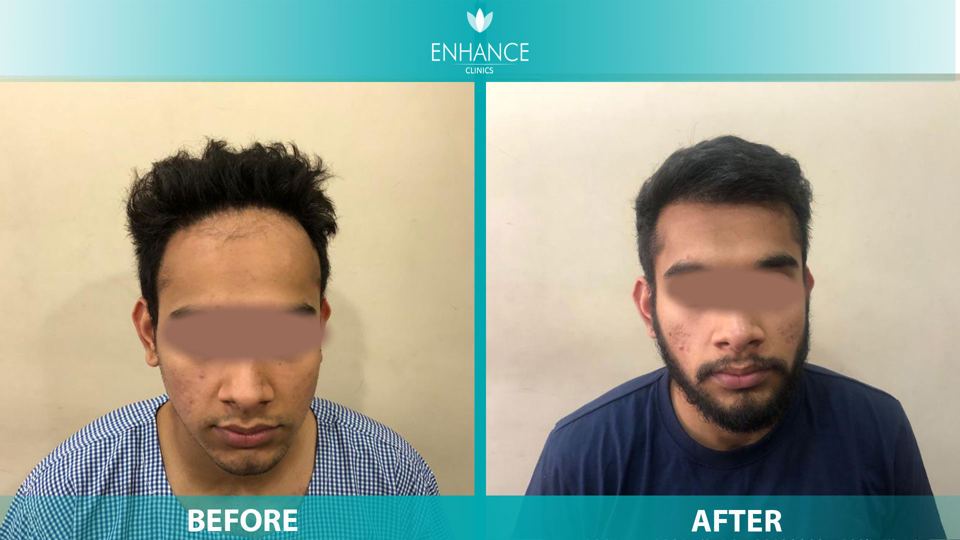 Best Hair Transplant in India | Best Hair Transplant Surgeon in india | Enhance  Clinic