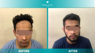 Hair Transplant Before & After