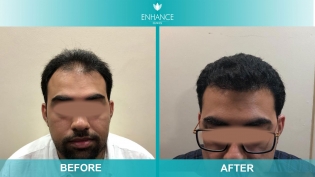 Hair Transplant Before & After