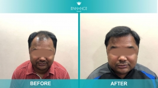 Best Hair Transplant in Mumbai  Hair Lose Treatment  Enhance Clinic