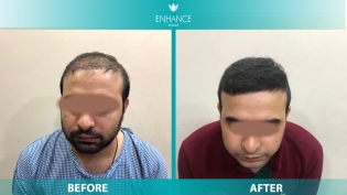 Hair Transplant Before & After