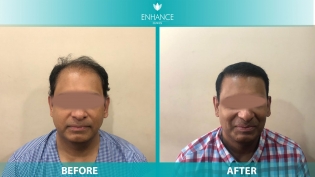 Hair Transplant Before & After