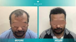 Hair Transplant Before & After