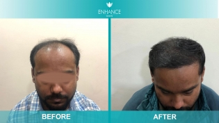 Hair Transplant Before & After