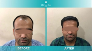 Hair Transplant Before & After