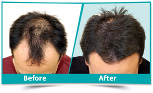 hair transplant before and after