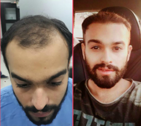 Hair Transplant Centre in Delhi