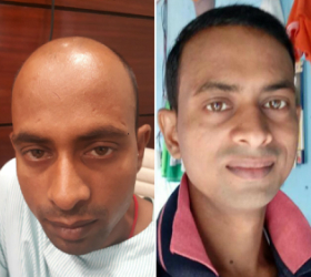 Cost of Hair Transplantation in India