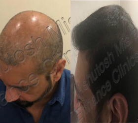 best hair transplant doctor in delhi