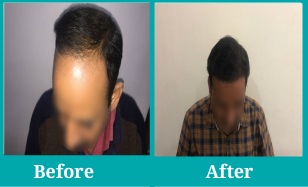 Delhi - FUE Hair Transplant Result