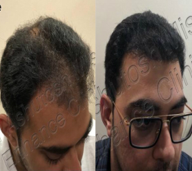 best hair transplant surgeon in delhi