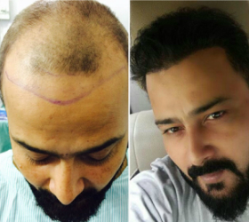 FUE Hair Transplant in Delhi FUE Hair Transplant Treatment in Delhi