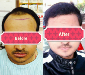 How Much Does A Hair Transplant Cost In India