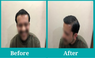 best hair transplant clinic