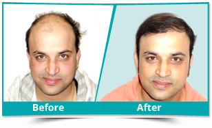 Hair Transplant Mumbai  Cost  Hair Transplant Clinic Mumbai