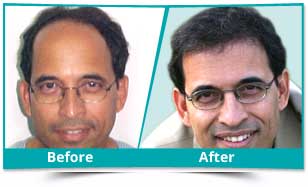 Hair Transplant Result Delhi