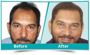 hair transplant surgeon