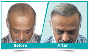 best hair transplant doctor