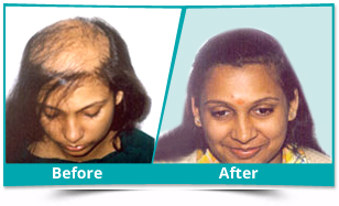 FUE Hair Transplant in Delhi, FUE Hair Transplant Treatment in Delhi